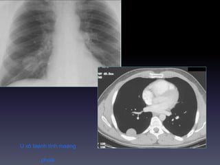 U xô laønh tính maøng
phoåi
 