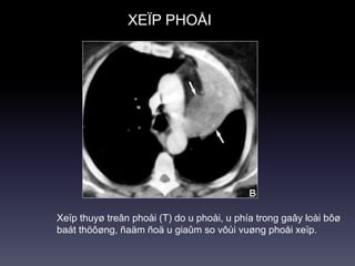 XEÏP PHOÅI
Xeïp thuyø treân phoåi (T) do u phoåi, u phía trong gaây loài bôø
baát thöôøng, ñaäm ñoä u giaûm so vôùi vuøng phoåi xeïp.
 