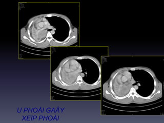 U PHOÅI GAÂY
XEÏP PHOÅI
 