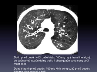 Daõn pheá quaûn vôùi daáu hieäu ñöôøng ray ( ‘tram line’ sign):
do daõn pheá quaûn daïng truï khi pheá quaûn song song vôùi
maët caét .
Daøy thaønh pheá quaûn: ñöôøng kính trong cuaû pheá quaûn/
 