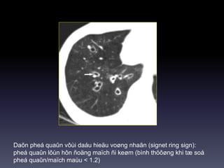 Daõn pheá quaûn vôùi daáu hieäu voøng nhaãn (signet ring sign):
pheá quaûn lôùn hôn ñoäng maïch ñi keøm (bình thöôøng khi tæ soá
pheá quaûn/maïch maùu < 1.2)
 