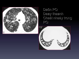 Daõn PQ
Daøy thaønh
Chaát nhaày trong
PQ
 