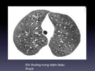 Khí thuõng trung taâm tieåu
thuyø
 