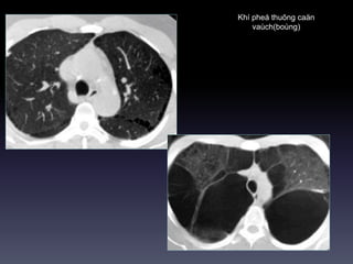 Khí pheá thuõng caän
vaùch(boùng)
 