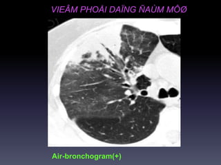 VIEÂM PHOÅI DAÏNG ÑAÙM MÔØ
Air-bronchogram(+)
 
