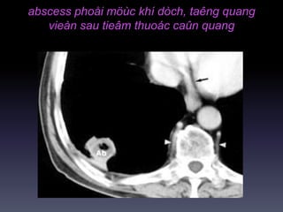 abscess phoåi möùc khí dòch, taêng quang
vieàn sau tieâm thuoác caûn quang
 