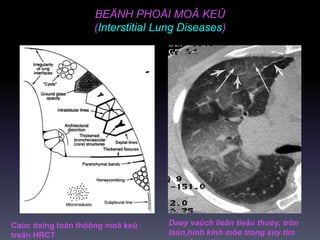 BEÄNH PHOÅI MOÂ KEÛ
(Interstitial Lung Diseases)
Daøy vaùch lieân tieåu thuøy, trôn
laùn,hình kính môø trong suy tim
Caùc daïng toån thöông moâ keû
treân HRCT
 