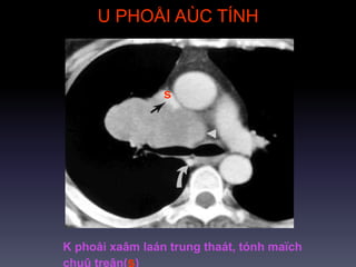 U PHOÅI AÙC TÍNH
K phoåi xaâm laán trung thaát, tónh maïch
chuû treân(s)
s
 
