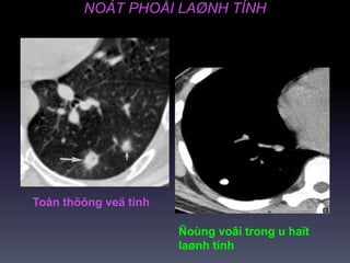 NOÁT PHOÅI LAØNH TÍNH
Toån thöông veä tinh
Ñoùng voâi trong u haït
laønh tính
 