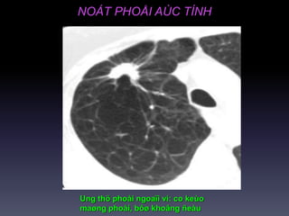 NOÁT PHOÅI AÙC TÍNH
Ung thö phoåi ngoaïi vi: co keùo
maøng phoåi, bôø khoâng ñeàu
 