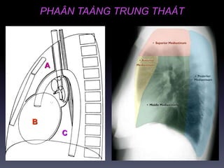 PHAÂN TAÀNG TRUNG THAÁT
B C
CC
A
 