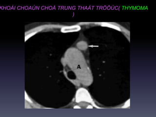 KHOÁI CHOAÙN CHOÅ TRUNG THAÁT TRÖÔÙC( THYMOMA
)
 