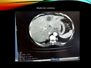 Abdomen window
 