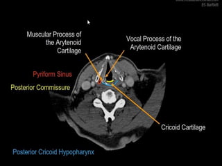 Ct of the larynx | PPTX