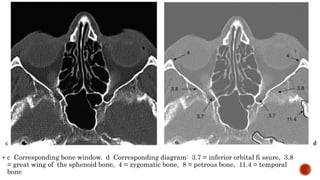  c Corresponding bone window. d Corresponding diagram: 3.7 = inferior orbital fi ssure, 3.8
= great wing of the sphenoid bone, 4 = zygomatic bone, 8 = petrous bone, 11.4 = temporal
bone
 