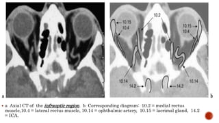  a Axial CT of the infraoptic region. b Corresponding diagram: 10.2 = medial rectus
muscle,10.4 = lateral rectus muscle, 10.14 = ophthalmic artery, 10.15 = lacrimal gland, 14.2
= ICA.
 