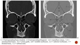  c Corresponding bone window. d Corresponding diagram: 1.2 = maxillary sinus, 1.3 =
nasolacrimal duct, 2.4 = crista galli, 2.6 = middle turbinate, 2.7 = inferior turbinate, 7 =
frontal bone, 7.1 = orbital roof.
 
