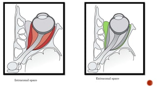 Intraconal space
Extraconal space
 