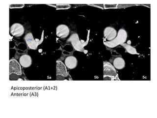CT Pulmonary Angiography | PPTX