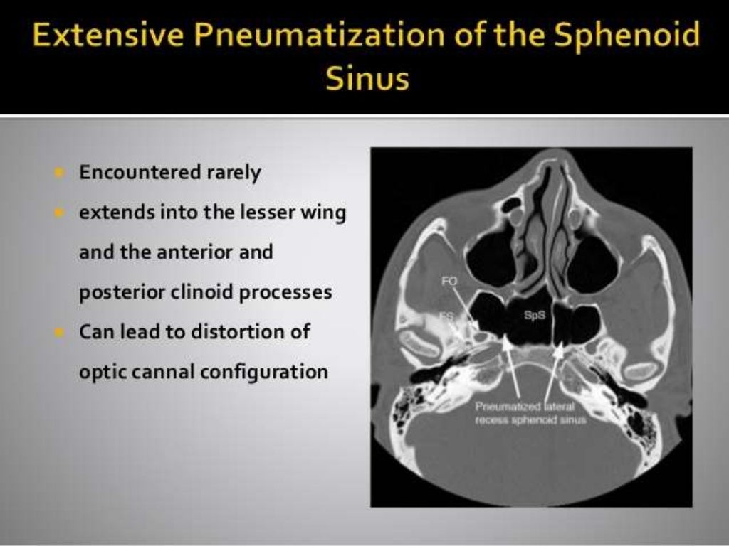 Ct anatomy of paranasal sinus