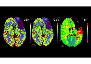 Neuro EM: Neuroimaging Nibble CTP mismatch in Acute Ischemic Stroke | PDF