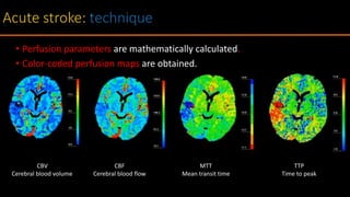 • Perfusion parameters are mathematically calculated.
• Color-coded perfusion maps are obtained.
CBV
Cerebral blood volume
CBF
Cerebral blood flow
MTT
Mean transit time
TTP
Time to peak
 