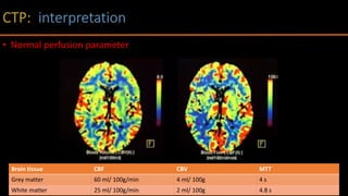 Brain tissue CBF CBV MTT
Grey matter 60 ml/ 100g/min 4 ml/ 100g 4 s
White matter 25 ml/ 100g/min 2 ml/ 100g 4.8 s
• Normal perfusion parameter
 