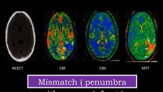 MTT
Mismatch ( penumbra
NCECT CBF CBV MTT
 