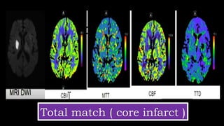 MTT
Total match ( core infarct )
 