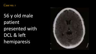 Case no. 1
56 y old male
patient
presented with
DCL & left
hemiparesis
 