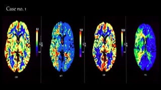 •CBV:
•MTT:
•CBF:
•TTP:
• Match/ mismatch
• Core/Penumbra
Case no. 1
 