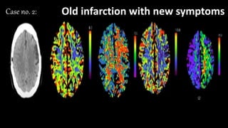 •CBV:
•MTT:
•CBF:
•TTP:
• Match/ mismatch
• Core/Penumbra
Case no. 2: Old infarction with new symptoms
 