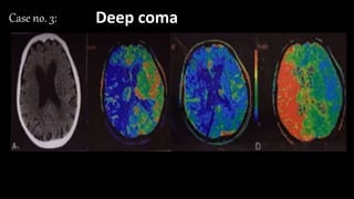 •CBV:
•MTT:
•CBF:
•TTP:
• Match/ mismatch
• Core/Penumbra
Case no. 3: Deep coma
 