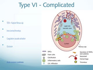 CTCA - CT Coronary Angiography Plaque Characterization | PPT