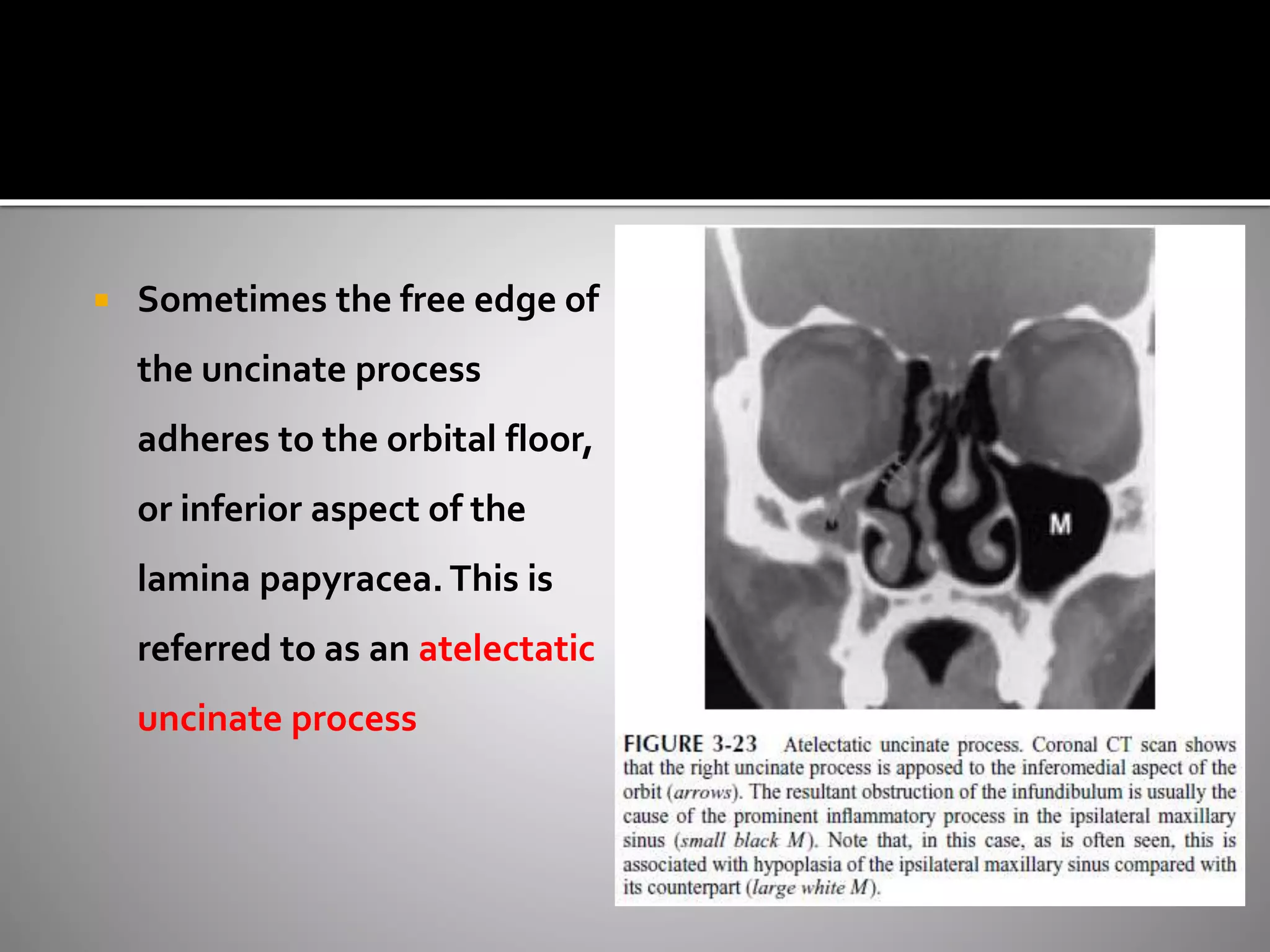  Sometimes the free edge of 
the uncinate process 
adheres to the orbital floor, 
or inferior aspect of the 
lamina papyracea. This is 
referred to as an atelectatic 
uncinate process 
 