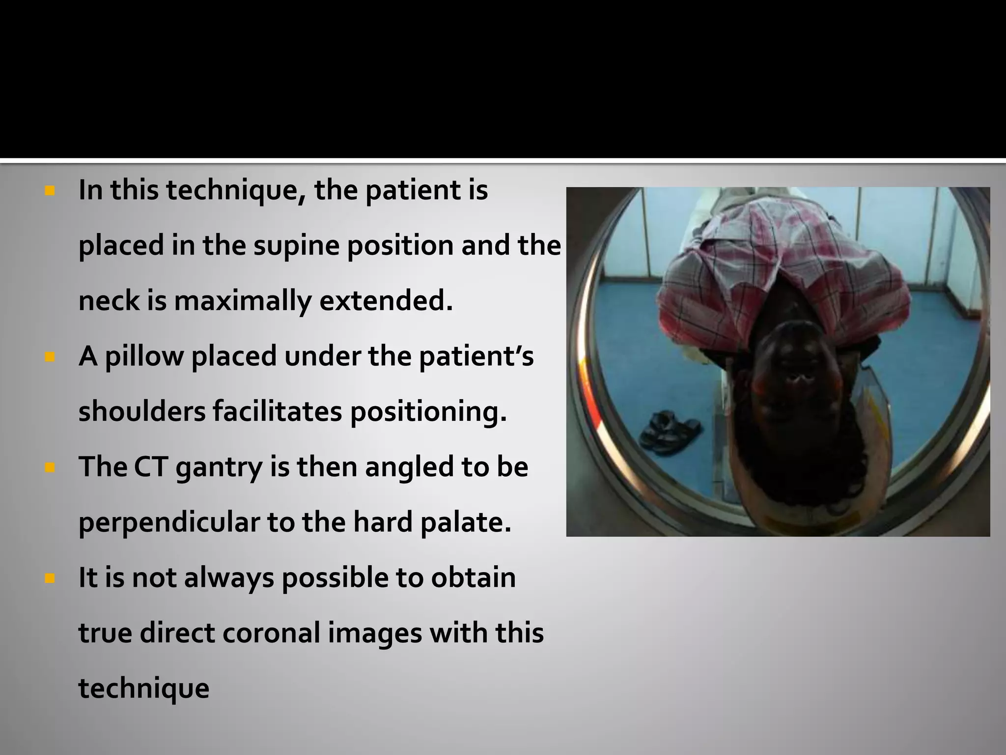  In this technique, the patient is 
placed in the supine position and the 
neck is maximally extended. 
 A pillow placed under the patient’s 
shoulders facilitates positioning. 
 The CT gantry is then angled to be 
perpendicular to the hard palate. 
 It is not always possible to obtain 
true direct coronal images with this 
technique 
 