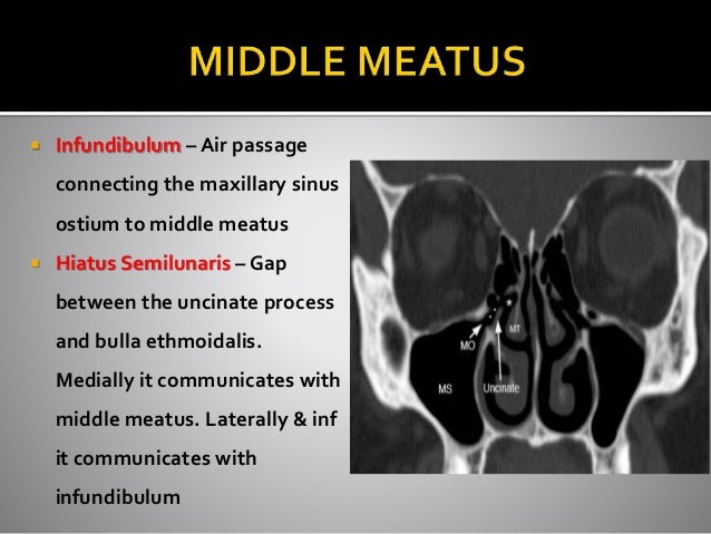 Ct Anatomy Of Para Nasal Sinuses Ct Anatomy Of Para Nasal Sinuses
