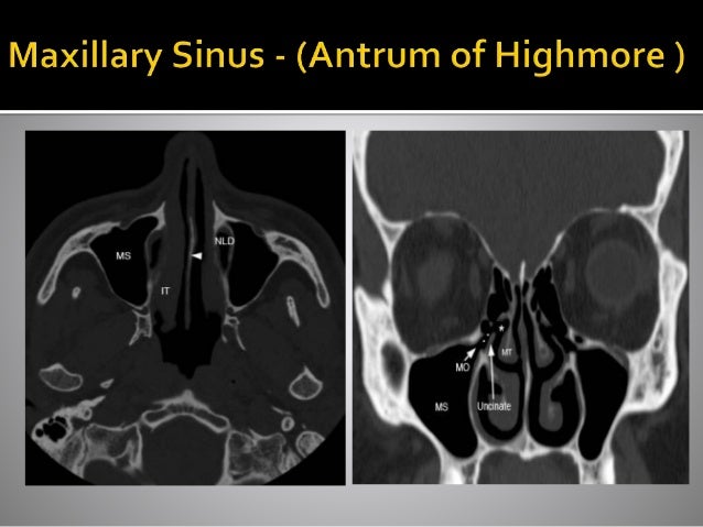 Ct Anatomy Of Para Nasal Sinuses Ct Anatomy Of Para Nasal Sinuses