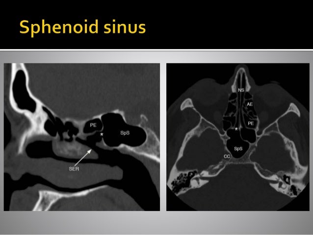 Ct Anatomy Of Para Nasal Sinuses Ct Anatomy Of Para Nasal Sinuses