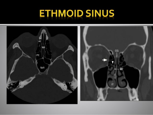 Ct Anatomy Of Para Nasal Sinuses Ct Anatomy Of Para Nasal Sinuses