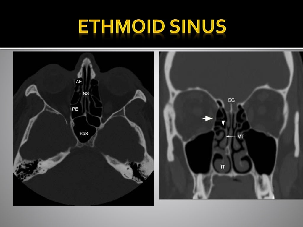 CT ANATOMY OF PARA NASAL SINUSES