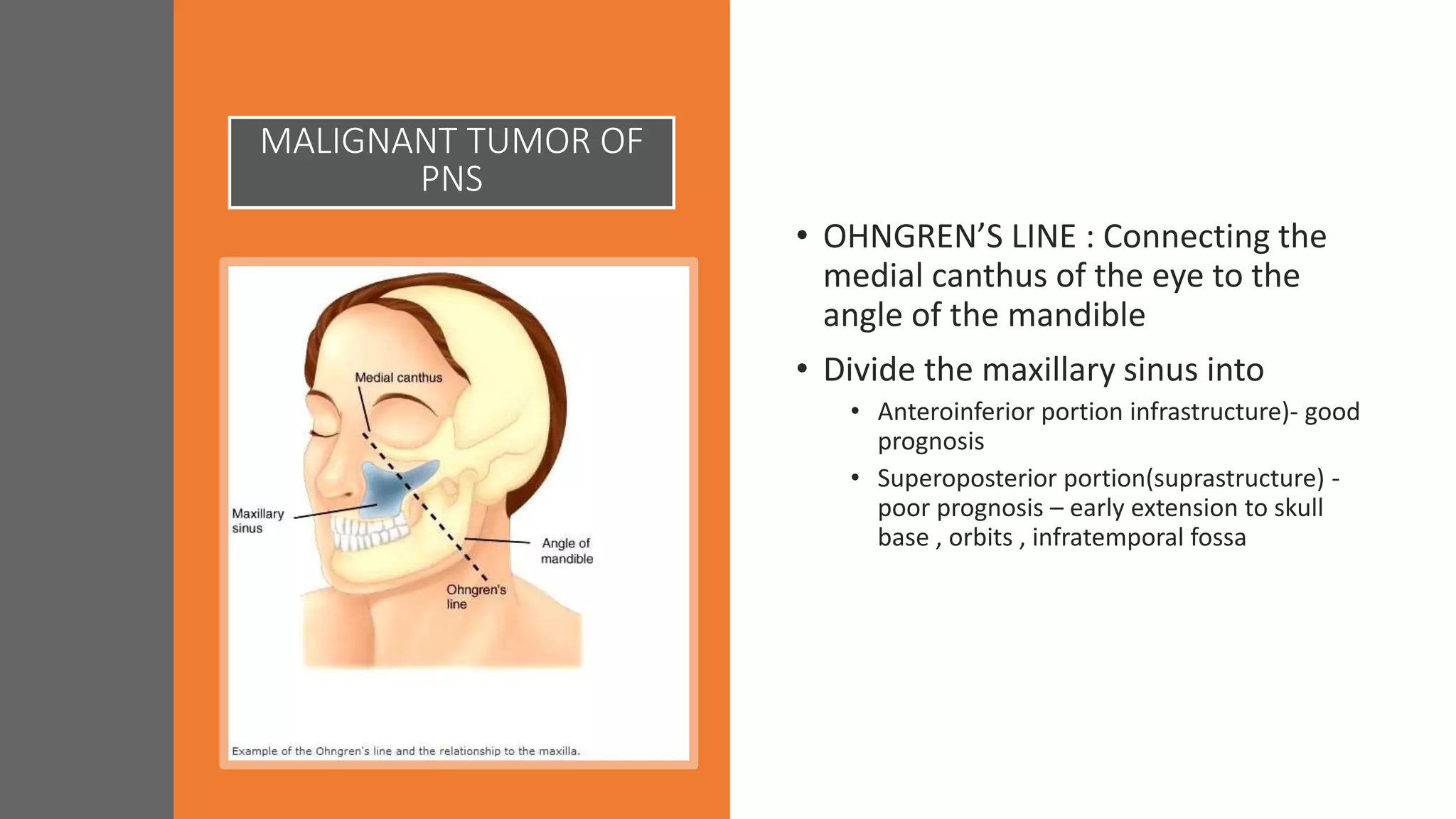MALIGNANT TUMOR OF
PNS
• OHNGREN’S LINE : Connecting the
medial canthus of the eye to the
angle of the mandible
• Divide the maxillary sinus into
• Anteroinferior portion infrastructure)- good
prognosis
• Superoposterior portion(suprastructure) -
poor prognosis – early extension to skull
base , orbits , infratemporal fossa
 