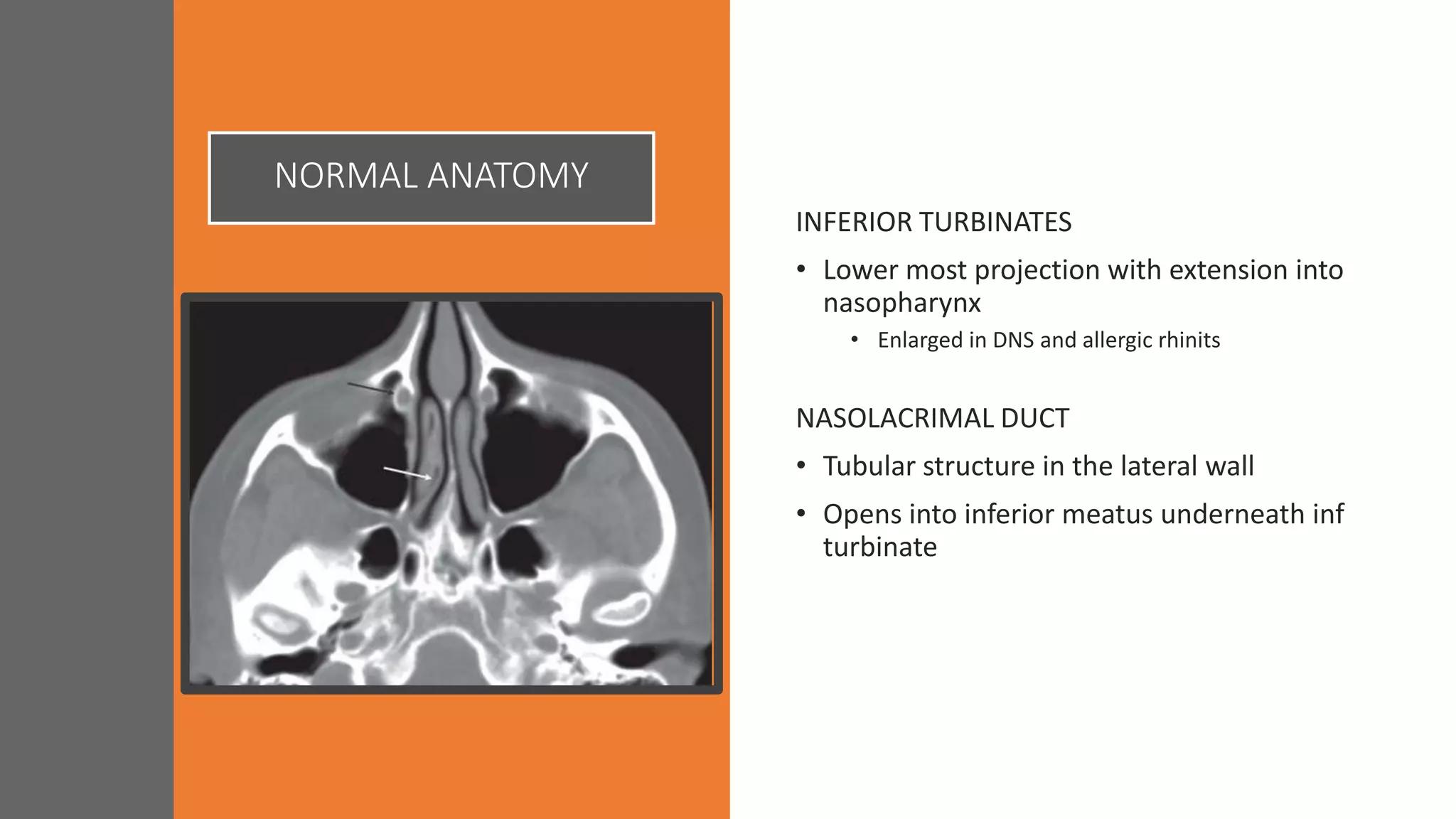 NORMAL ANATOMY
INFERIOR TURBINATES
• Lower most projection with extension into
nasopharynx
• Enlarged in DNS and allergic rhinits
NASOLACRIMAL DUCT
• Tubular structure in the lateral wall
• Opens into inferior meatus underneath inf
turbinate
 