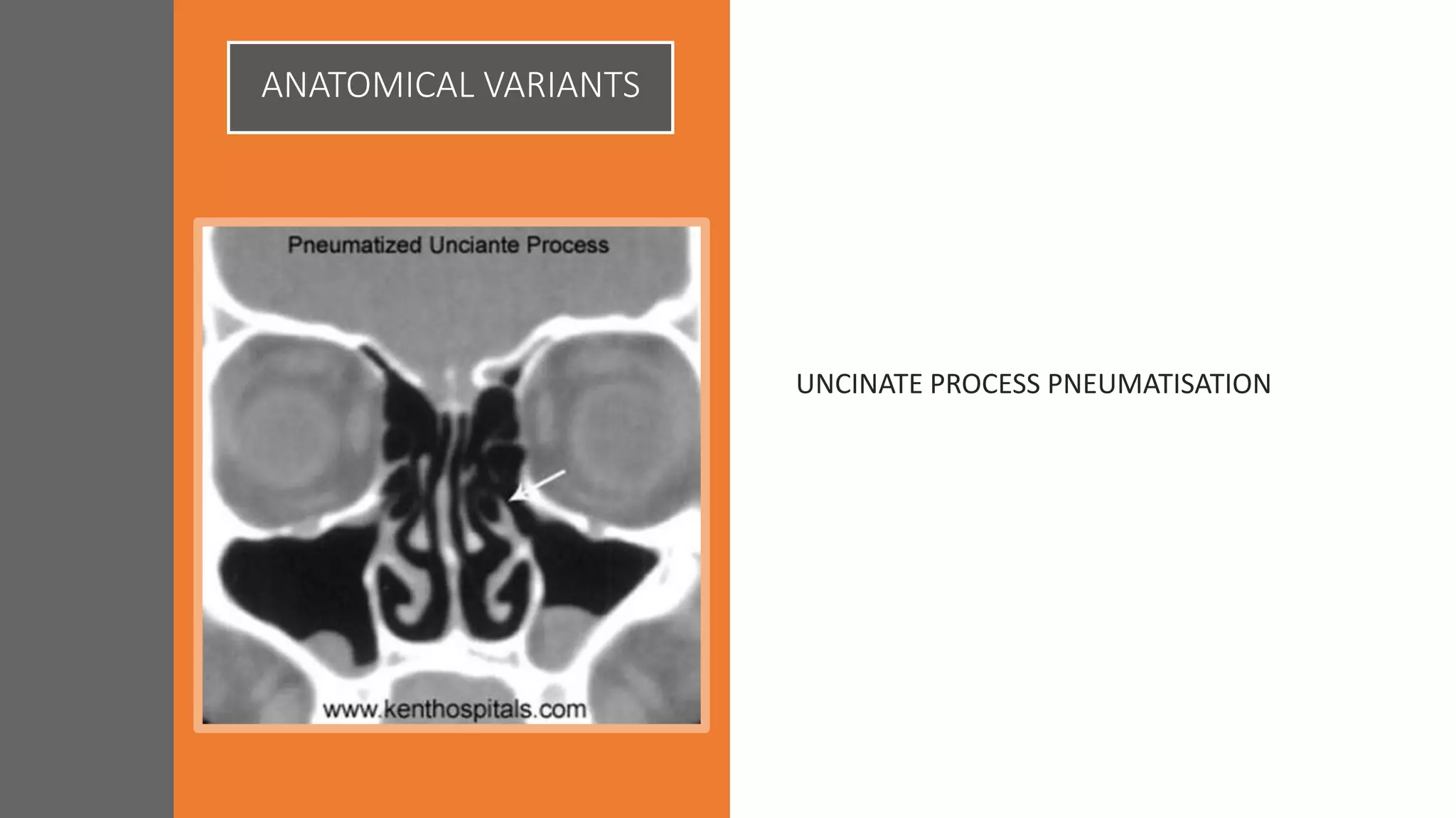 ANATOMICAL VARIANTS
UNCINATE PROCESS PNEUMATISATION
 