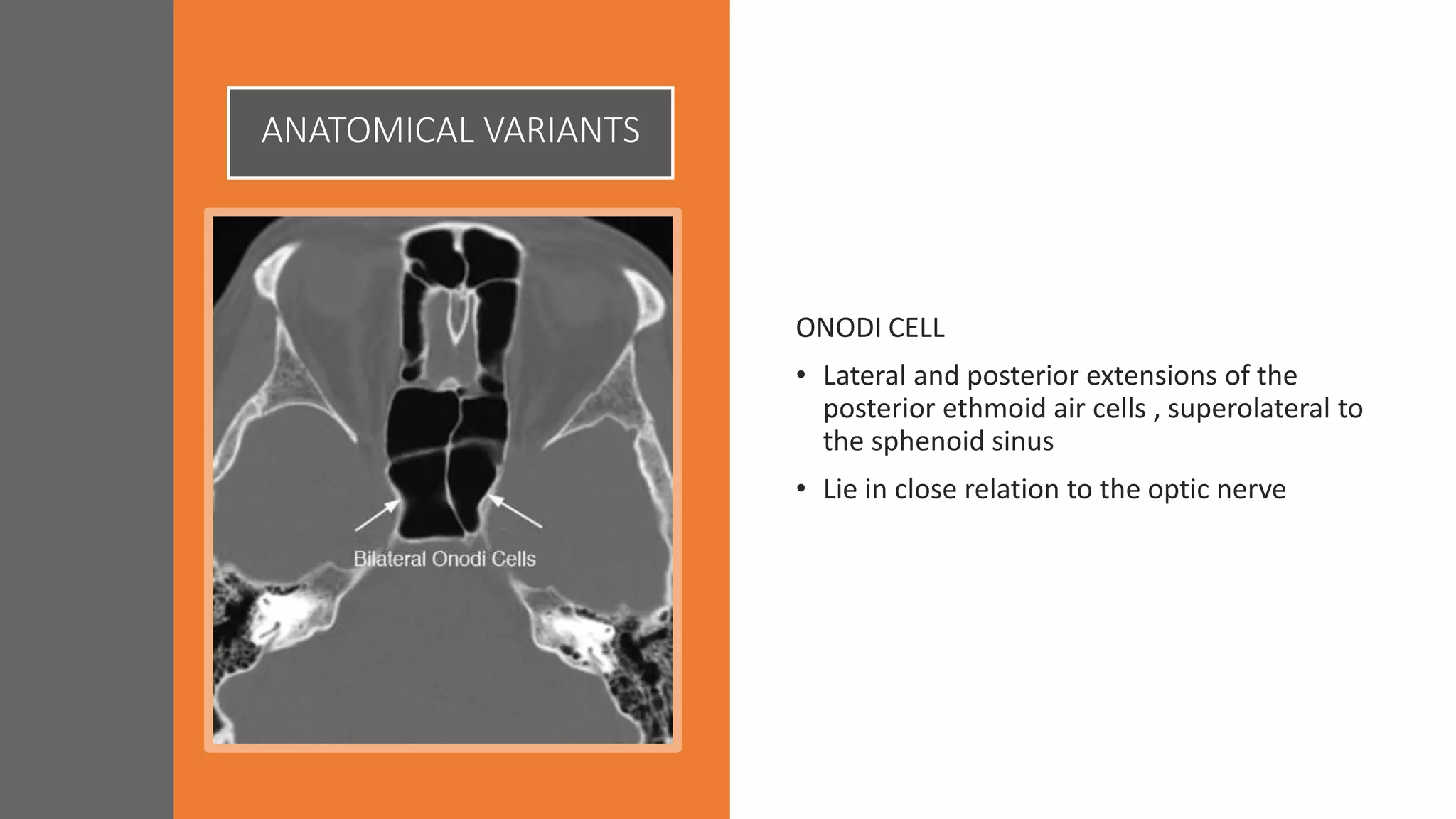 ANATOMICAL VARIANTS
ONODI CELL
• Lateral and posterior extensions of the
posterior ethmoid air cells , superolateral to
the sphenoid sinus
• Lie in close relation to the optic nerve
 