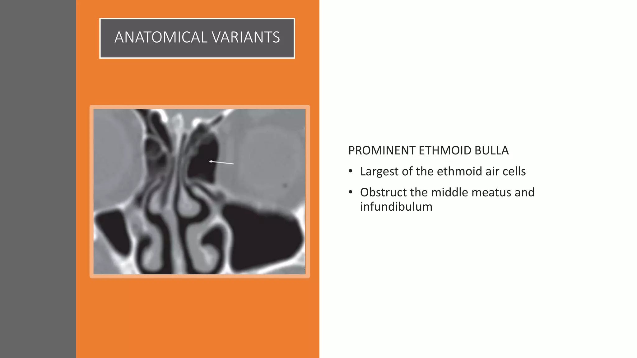 ANATOMICAL VARIANTS
PROMINENT ETHMOID BULLA
• Largest of the ethmoid air cells
• Obstruct the middle meatus and
infundibulum
 