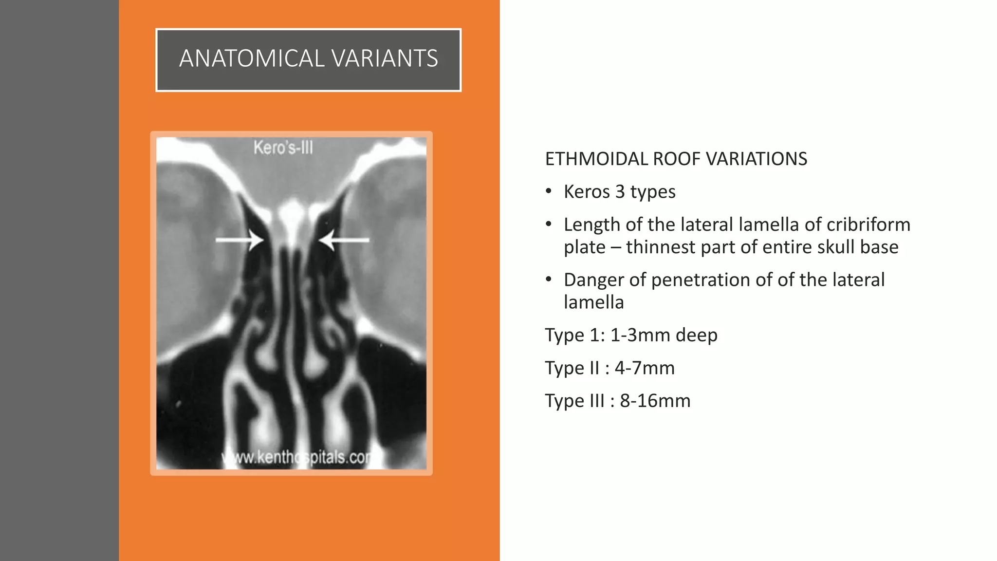 ANATOMICAL VARIANTS
ETHMOIDAL ROOF VARIATIONS
• Keros 3 types
• Length of the lateral lamella of cribriform
plate – thinnest part of entire skull base
• Danger of penetration of of the lateral
lamella
Type 1: 1-3mm deep
Type II : 4-7mm
Type III : 8-16mm
 