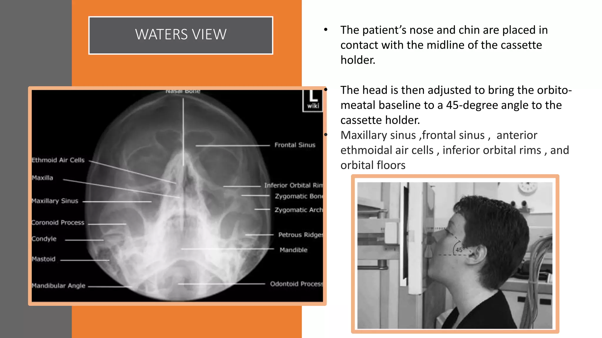 WATERS VIEW • The patient’s nose and chin are placed in
contact with the midline of the cassette
holder.
• The head is then adjusted to bring the orbito-
meatal baseline to a 45-degree angle to the
cassette holder.
• Maxillary sinus ,frontal sinus , anterior
ethmoidal air cells , inferior orbital rims , and
orbital floors
 