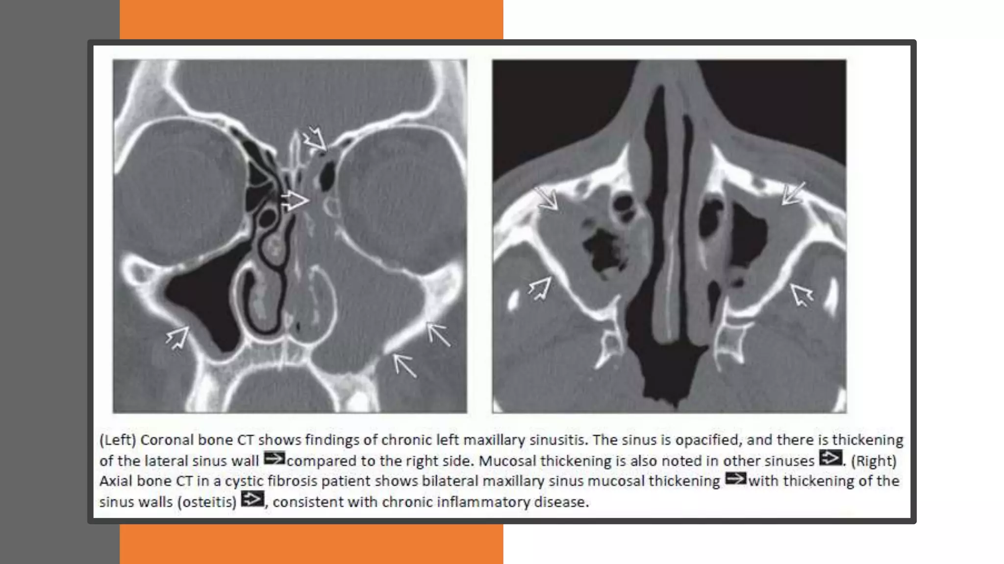 CHRONIC SINUSITIS
 