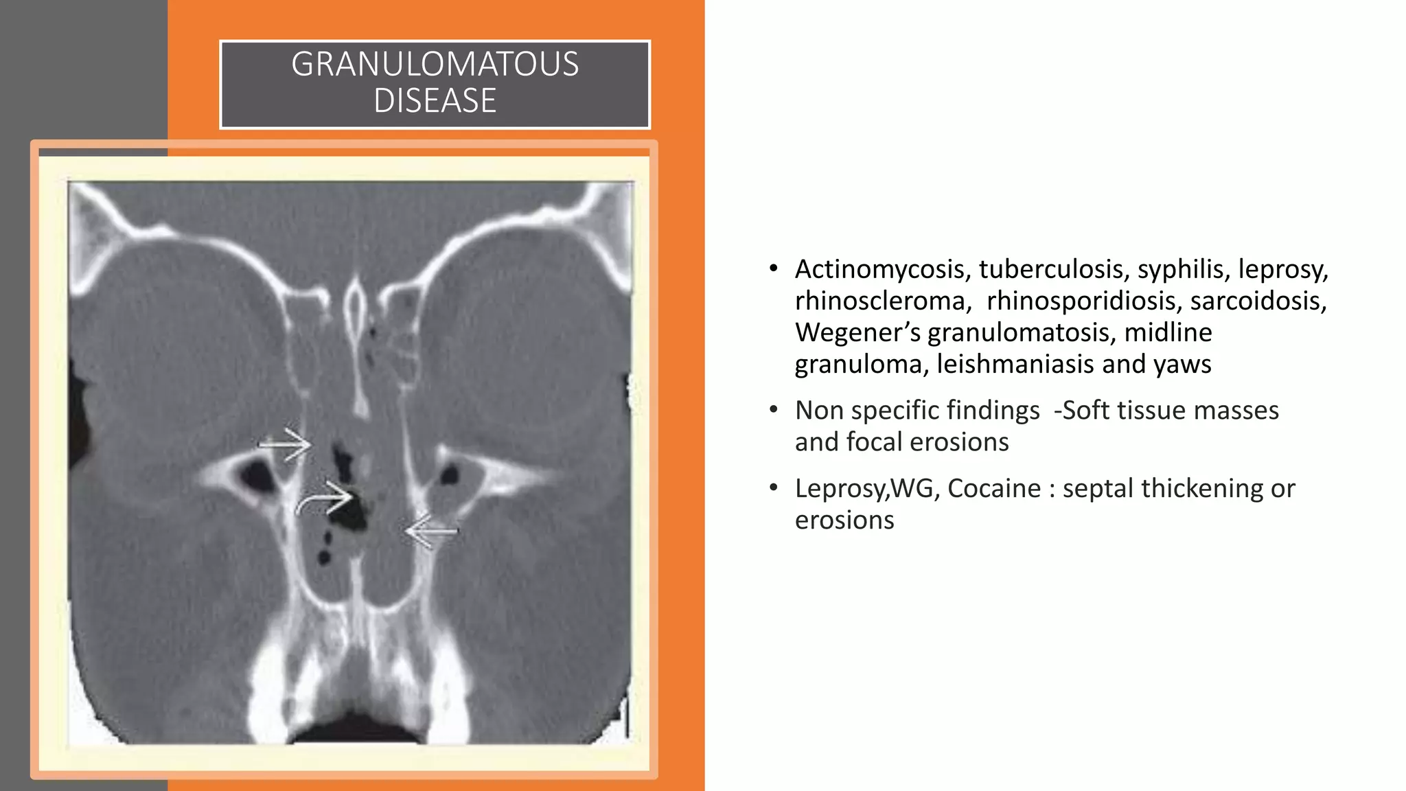 GRANULOMATOUS
DISEASE
• Actinomycosis, tuberculosis, syphilis, leprosy,
rhinoscleroma, rhinosporidiosis, sarcoidosis,
Wegener’s granulomatosis, midline
granuloma, leishmaniasis and yaws
• Non specific findings -Soft tissue masses
and focal erosions
• Leprosy,WG, Cocaine : septal thickening or
erosions
 